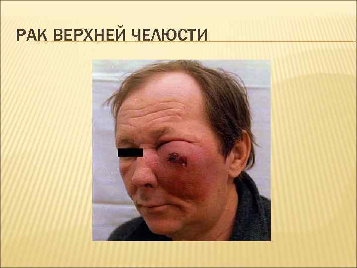 РАК ВЕРХНЕЙ ЧЕЛЮСТИ 