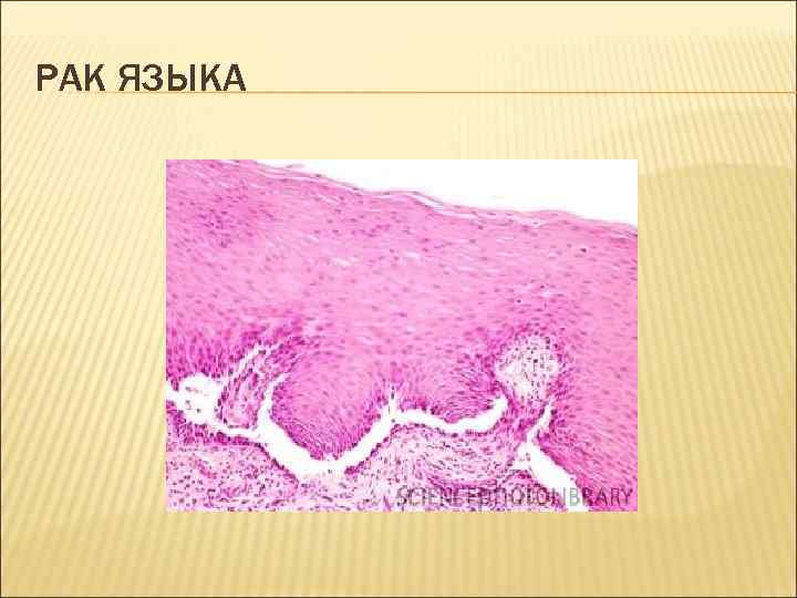 РАК ЯЗЫКА 