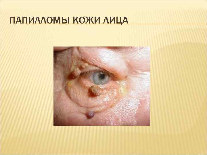 ПАПИЛЛОМЫ КОЖИ ЛИЦА 