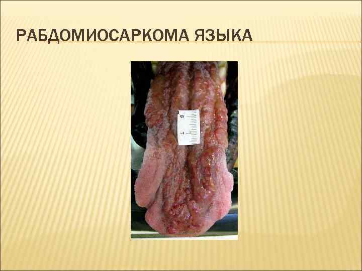 РАБДОМИОСАРКОМА ЯЗЫКА 