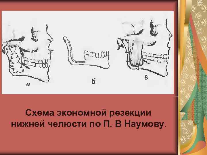  Схема экономной резекции нижней челюсти по П. В Наумову. 