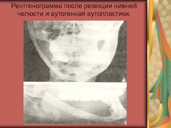 Рентгенограмма после резекции нижней  челюсти и аутогенная аутопластики. 
