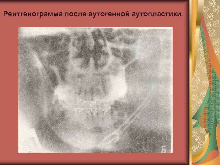 Рентгенограмма после аутогенной аутопластики. 
