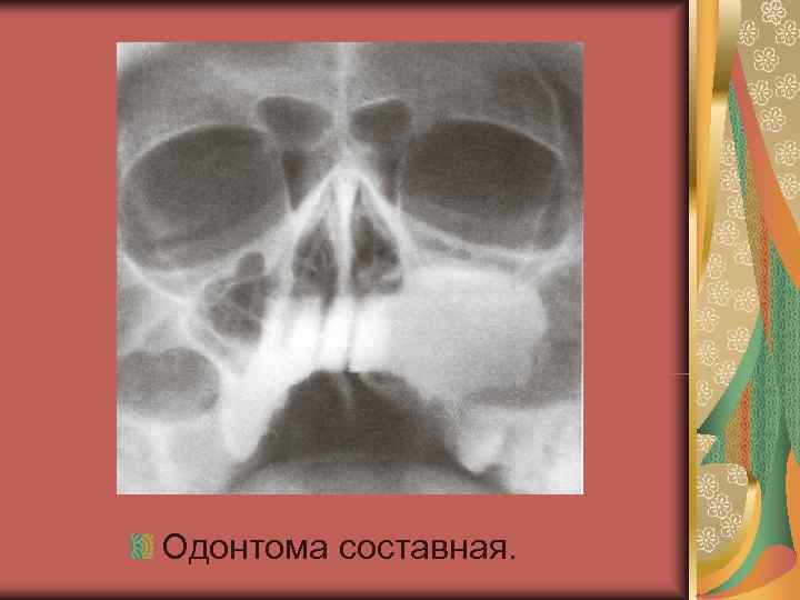 Одонтома составная. 