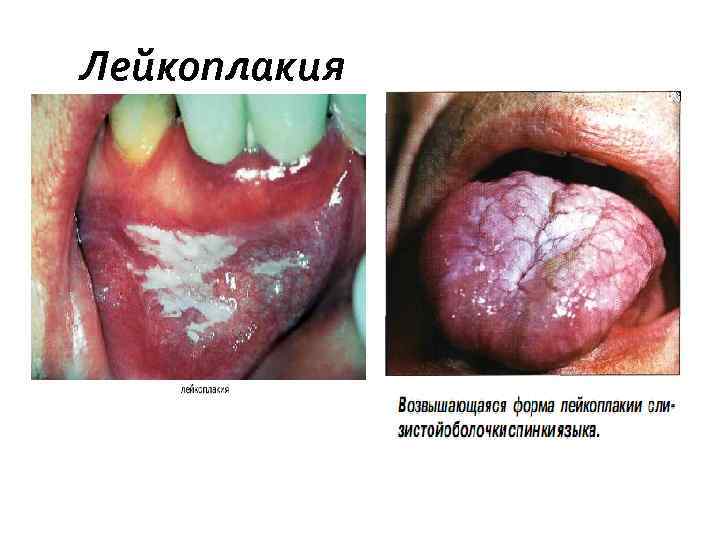 Лейкоплакия 
