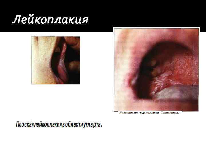 Лейкоплакия 