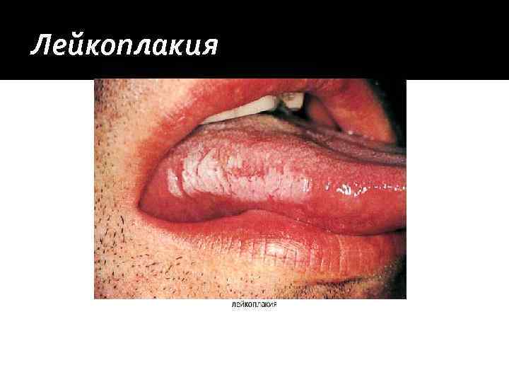Лейкоплакия 