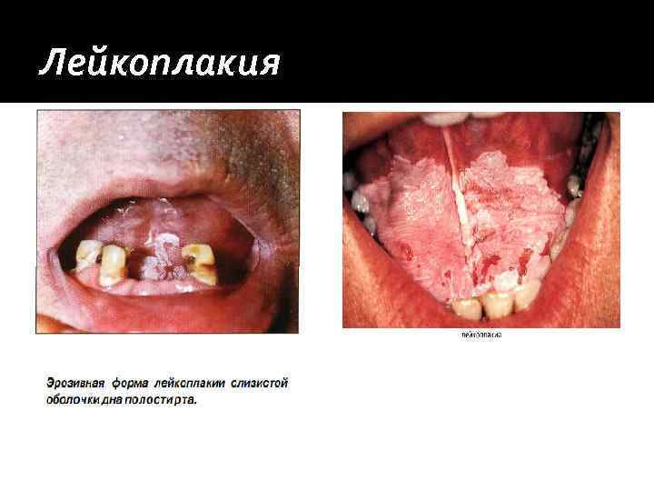 Лейкоплакия 