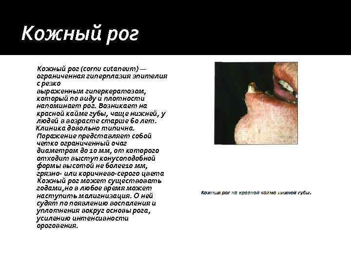 Кожный рог (cornu cutaneum) — ограниченная гиперплазия эпителия с резко выраженным гиперкератозом,  который
