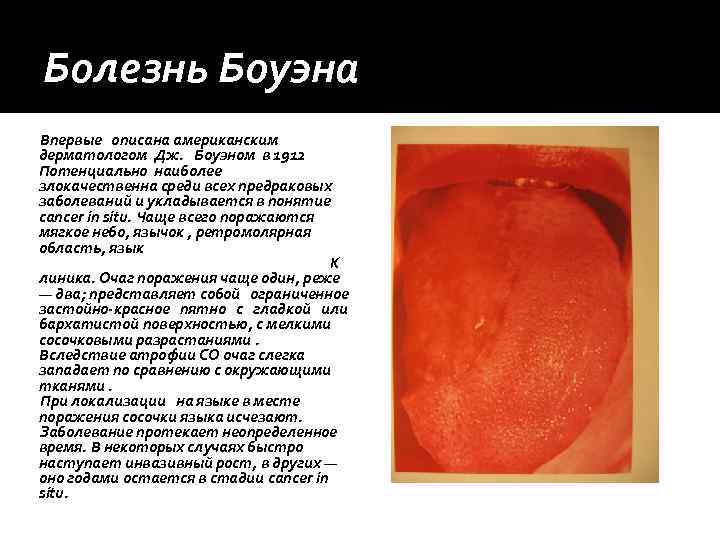 Болезнь Боуэна Впервые описана американским дерматологом Дж. Боуэном в 1912 Потенциально наиболее злокачественна среди