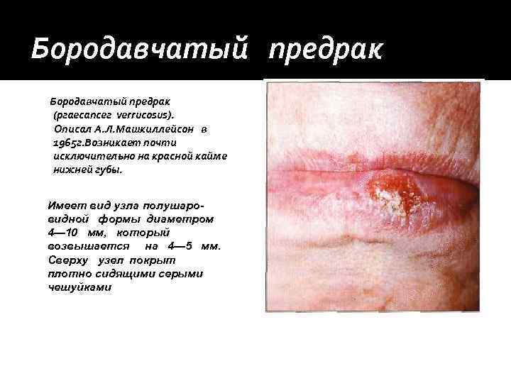 Бородавчатый предрак  (ргаесапсег verrucosus).  Описал А. Л. Машкиллейсон в  1965 г.
