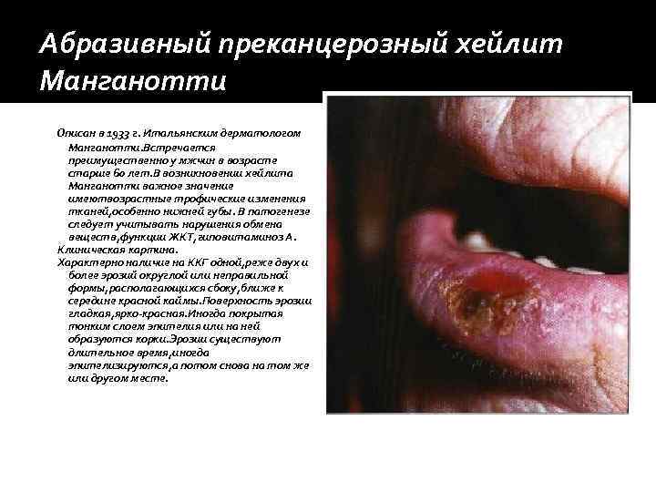 Абразивный преканцерозный хейлит Манганотти Описан в 1933 г. Итальянским дерматологом  Манганотти. Встречается 