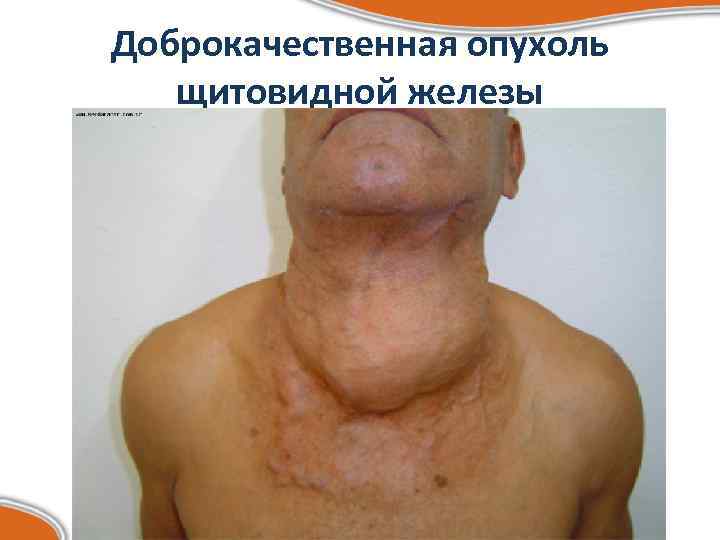 Доброкачественная опухоль  щитовидной железы 