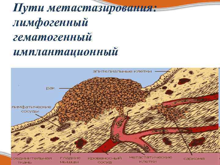 Пути метастазирования: лимфогенный гематогенный имплантационный 