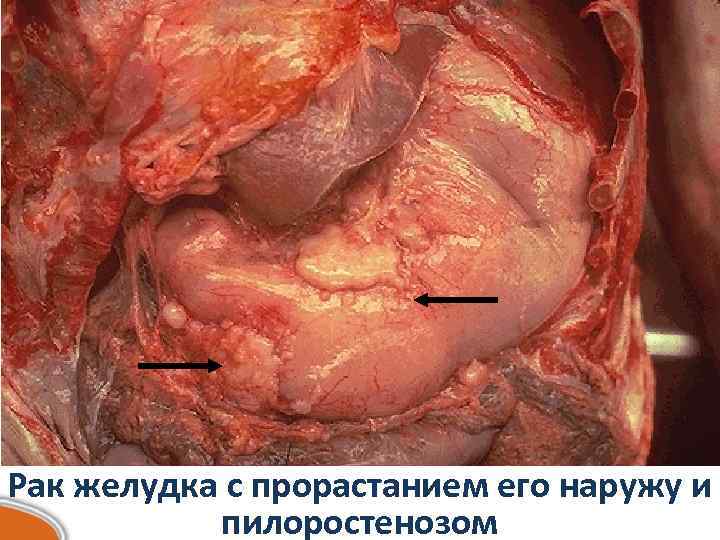 Рак желудка с прорастанием его наружу и  пилоростенозом 