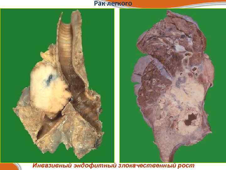     Рак легкого Инвазивный эндофитный злокачественный рост 
