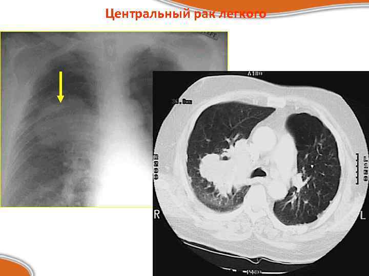 Центральный рак легкого 