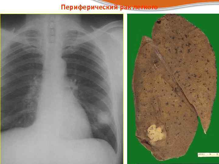 Периферический рак легкого 