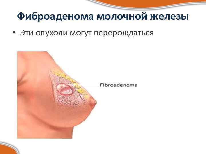  Фиброаденома молочной железы • Эти опухоли могут перерождаться 