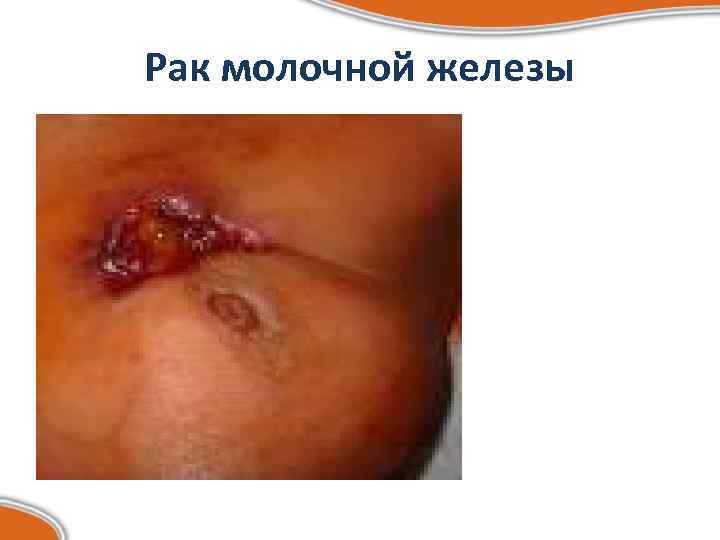 Рак молочной железы 