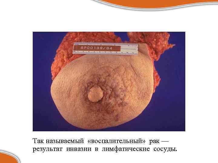 Так называемый «воспалительный» рак — результат инвазии в лимфатические сосуды. 