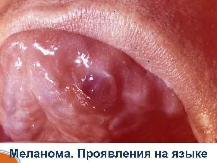 Меланома. Проявления на языке 