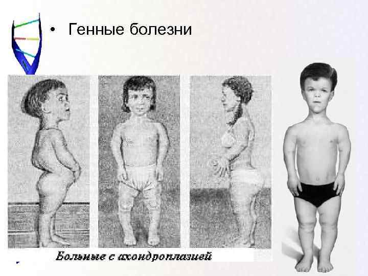  •  Генные болезни 