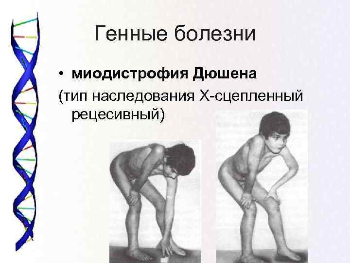  Генные болезни • миодистрофия Дюшена (тип наследования Х-сцепленный  рецесивный) 