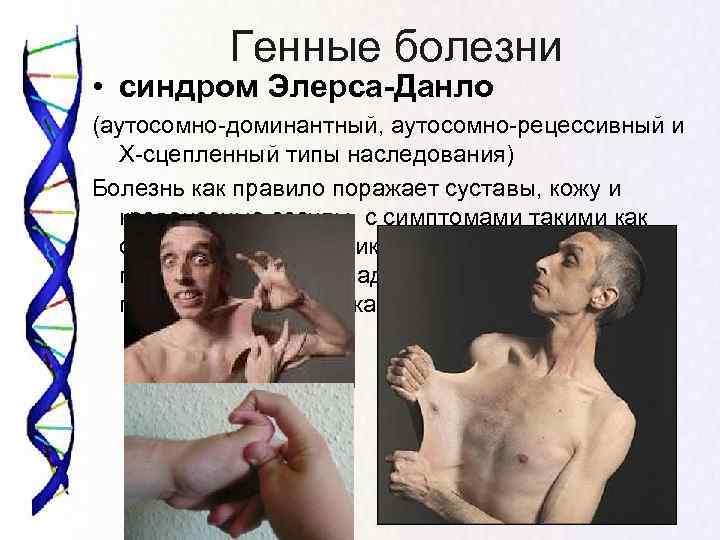   Генные болезни • синдром Элерса-Данло (аутосомно-доминантный, аутосомно-рецессивный и  Х-сцепленный типы наследования)
