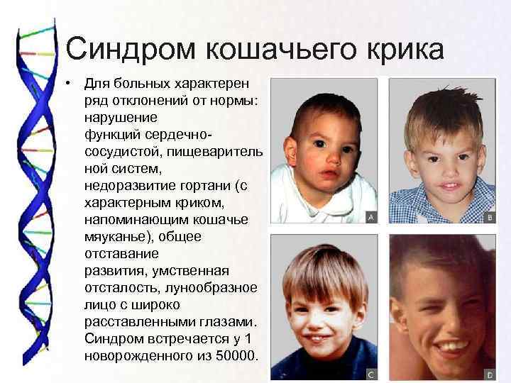 Синдром кошачьего крика • Для больных характерен  ряд отклонений от нормы: нарушение 