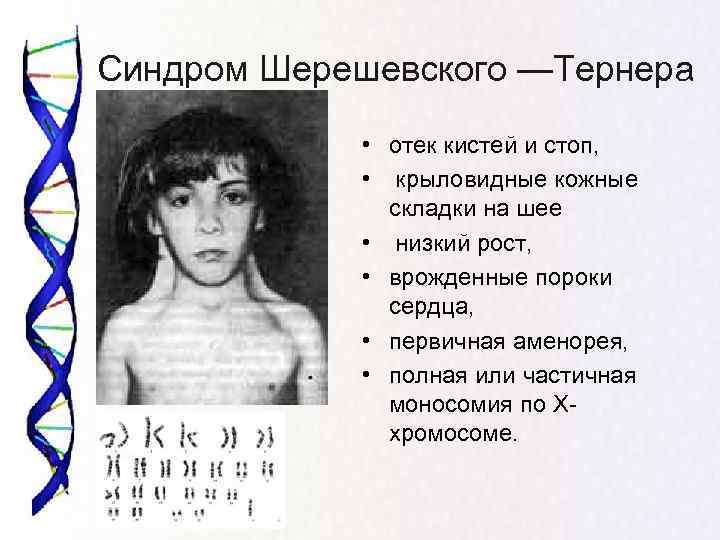 Синдром Шерешевского —Тернера    • отек кистей и стоп,   