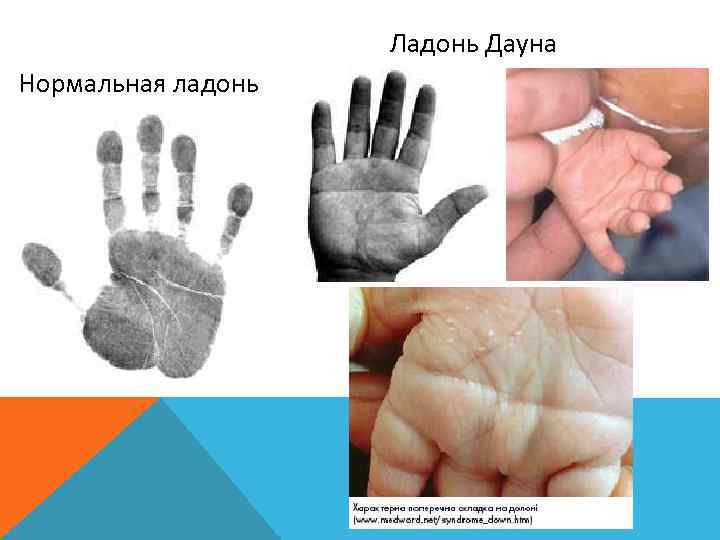     Ладонь Дауна Нормальная ладонь 