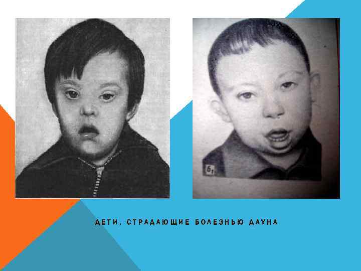 ДЕТИ, СТРАДАЮЩИЕ БОЛЕЗНЬЮ ДАУНА 