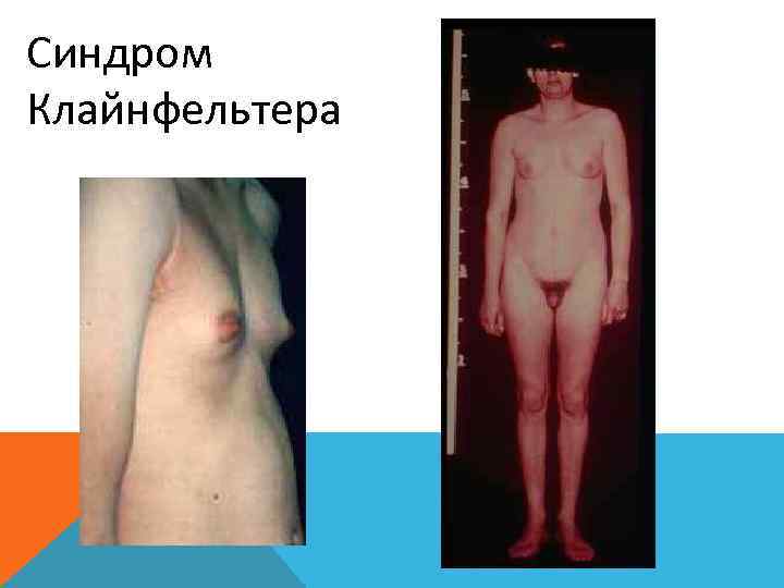 Синдром Клайнфельтера 