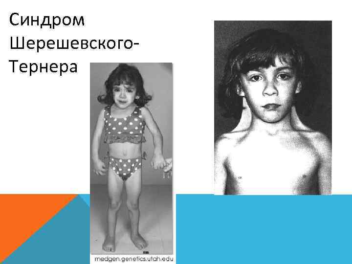 Синдром Шерешевского- Тернера 