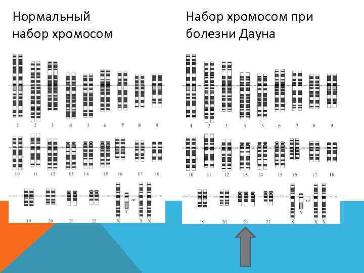 Нормальный  Набор хромосом при набор хромосом    болезни Дауна  