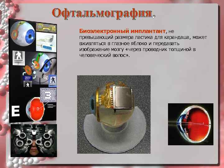 Офтальмография. Биоэлектронный имплантант, не превышающий размера ластика для карандаша, может вживляться в глазное яблоко