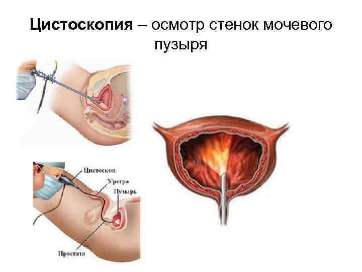 Цистоскопия мочевого. Стенка мочевого пузыря при цистоскопии. Цистоскопия мочевого пузыря у женщин обезболивание. Обезболивание при цистоскопии мочевого пузыря у мужчин.