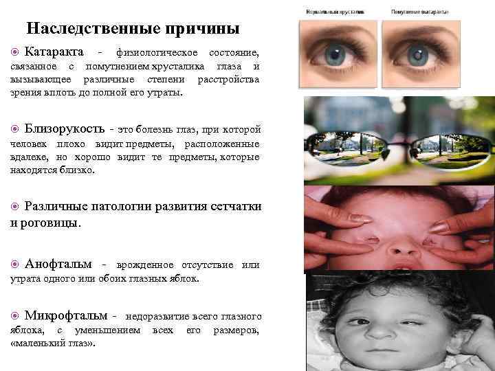   Наследственные причины Катаракта - физиологическое состояние,  связанное с помутнением хрусталика глаза