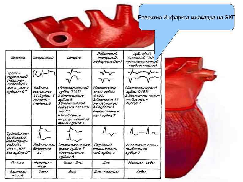 Формы инфаркта миокарда