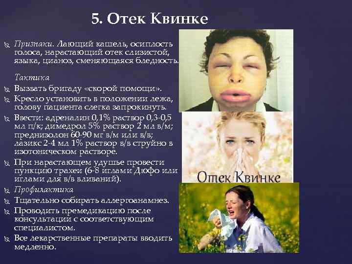      5. Отек Квинке Признаки. Лающий кашель, осиплость голоса, нарастающий