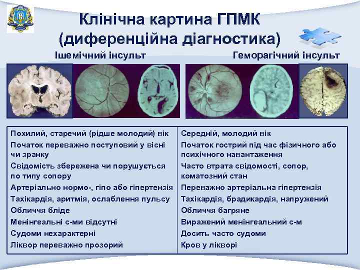 Клінічна картина ГПМК (диференційна діагностика) Ішемічний інсульт Похилий, старечий (рідше молодий) вік Початок переважно