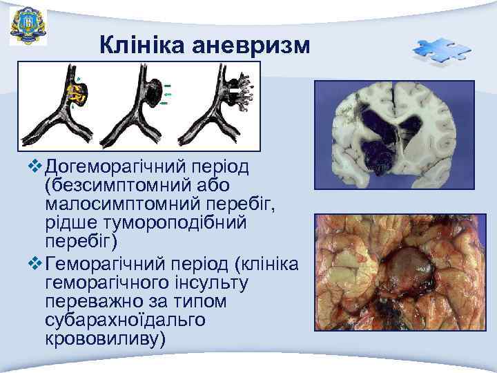 Клініка аневризм v Догеморагічний період (безсимптомний або малосимптомний перебіг, рідше тумороподібний перебіг) v Геморагічний