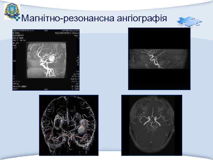 v. Магнітно-резонансна ангіографія 
