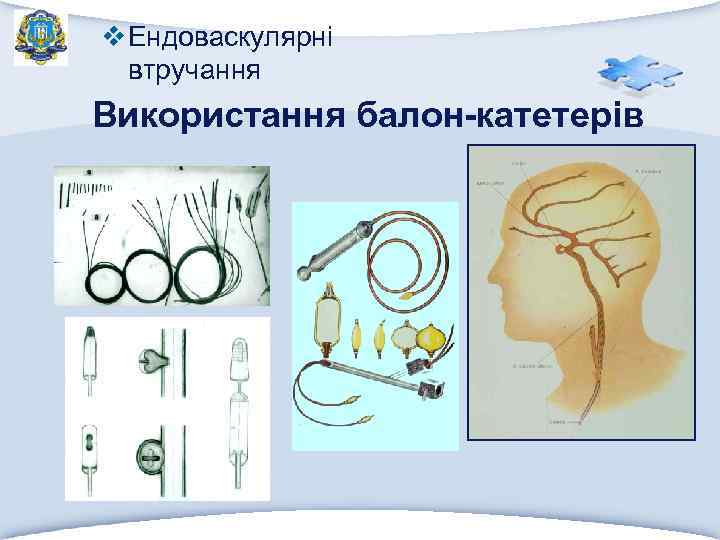 v Ендоваскулярні втручання Використання балон-катетерів 