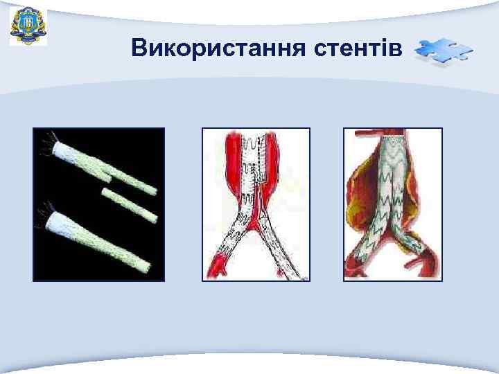Використання стентів 