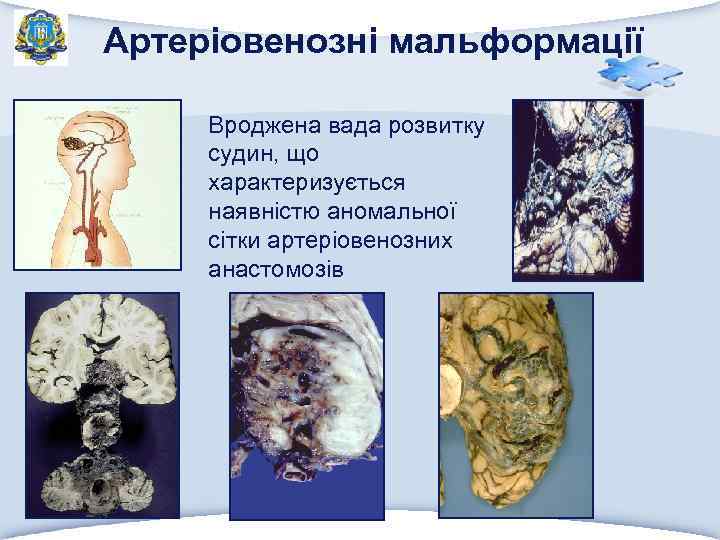 Артеріовенозні мальформації Вроджена вада розвитку судин, що характеризується наявністю аномальної сітки артеріовенозних анастомозів 