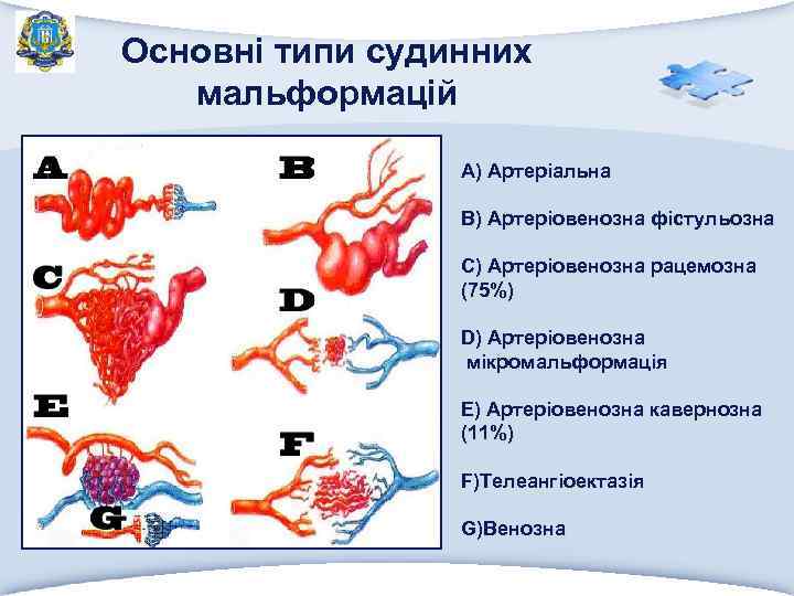 Основні типи судинних мальформацій A) Артеріальна В) Артеріовенозна фістульозна С) Артеріовенозна рацемозна (75%) D)