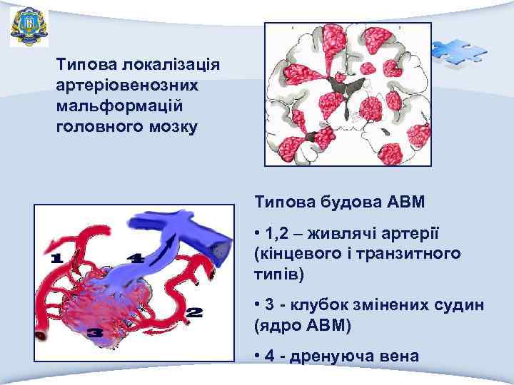 Типова локалізація артеріовенозних мальформацій головного мозку Типова будова АВМ • 1, 2 – живлячі