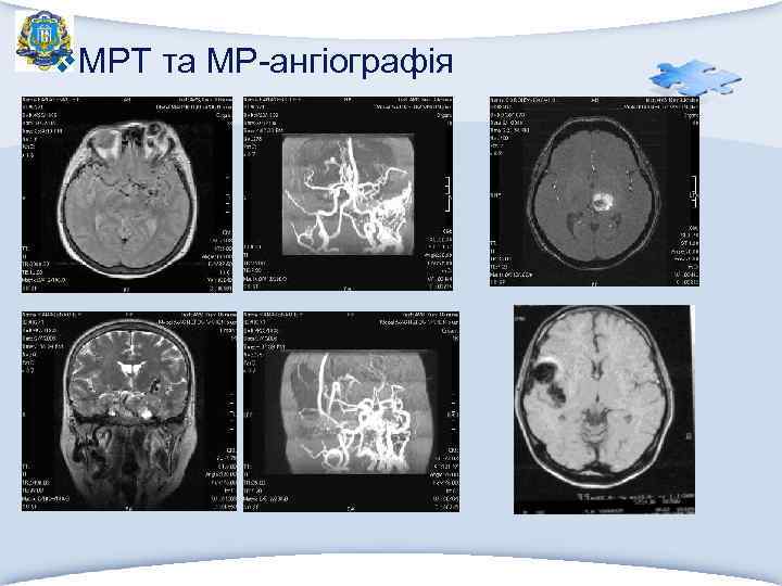v. МРТ та МР-ангіографія 